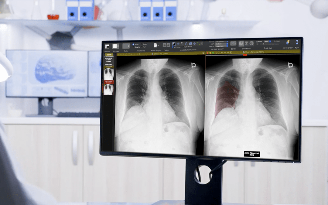 How AI is Helping Diagnose Lung Abnormalities