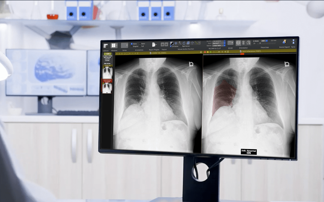 How-AI-is-Helping-Diagnose-Lung-Abnormalities